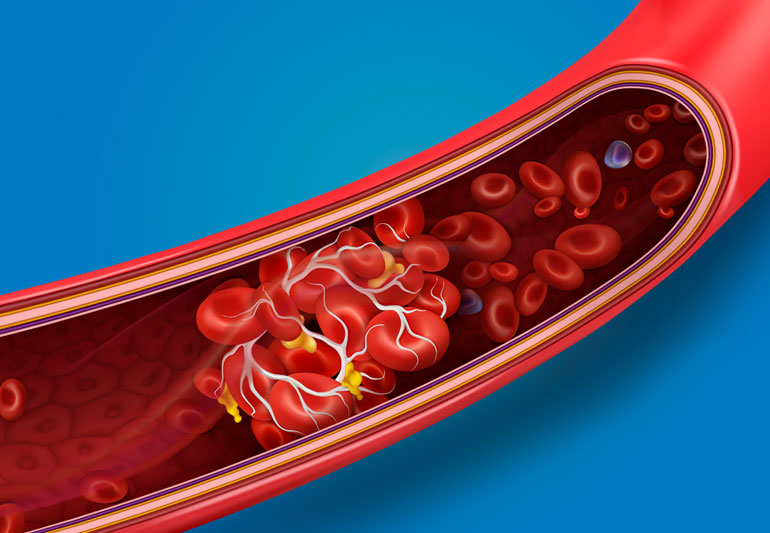 Modern experts: Blood clots arise from dehydration